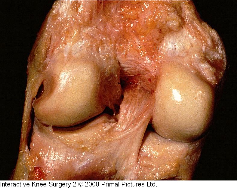 Fig.1-B = LCP – vista posterior do joelho. Fonte: Interactive Knee Surgery 2 / 2000. Primal            Pictures Ltda.