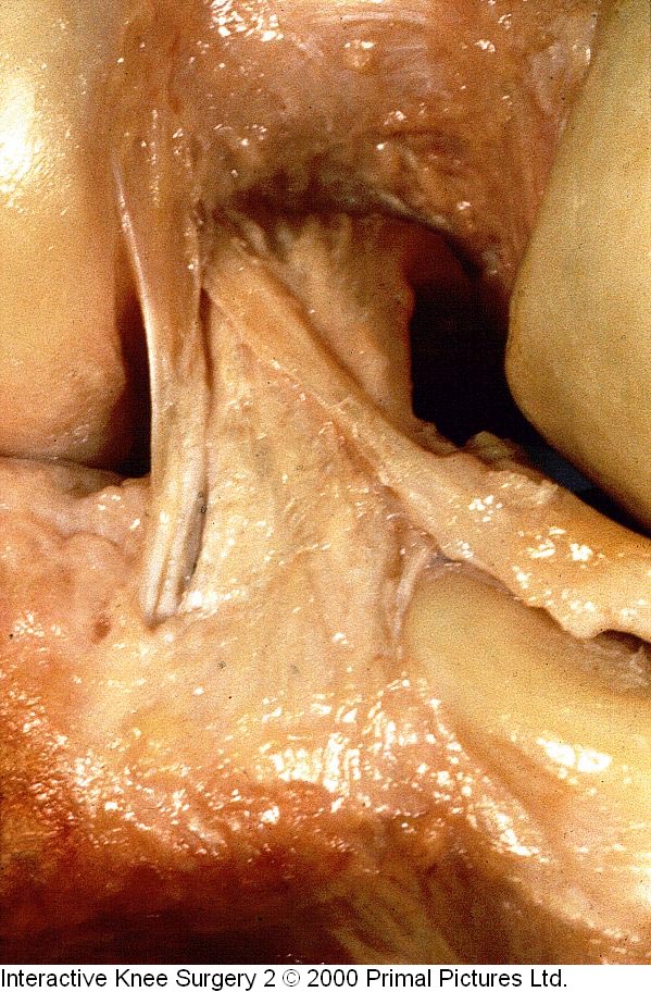 Fig.1-C = LCP / ligamentos menisco-femorais. Fonte: Interactive Knee Surgery 2 / 2000.             Primal Pictures Ltda.