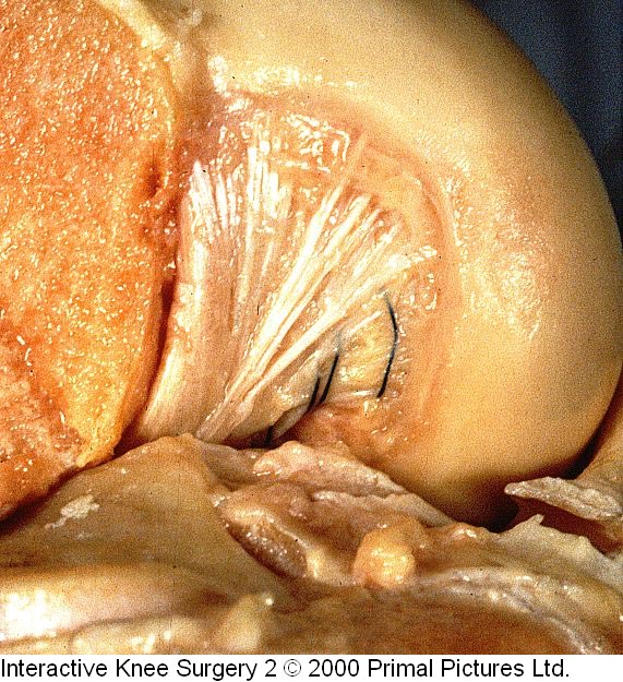 Fig.2-B = LCP – inserção femoral. Fonte: Interactive Knee Surgery 2 / 2000. Primal Pictures Ltda.