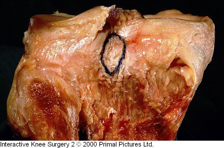 Fig.2-C = LCP – inserção tibial. Fonte Interactive Knee Surgery 2 / 2000. Primal Pictures Ltda.
