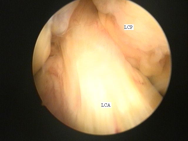 Fig.3-A = Artroscopia. LCA e LCP normal