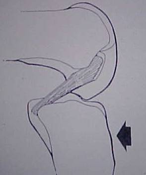 Fig.4-A - B = Mecanismo de trauma – Queda / trauma em flexão – extensão.                 Fonte: Miller M. Sports Medicine And Arthroscopy Review 2: 101, 1994.