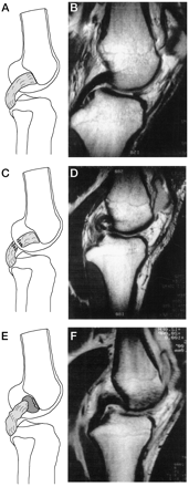 Fig.11 = Ressonância Magnética – A-B: LCP normal  /  C-D: lesão no corpo do LCP /         E-F: desinserção do fêmur (“peel off”).         Fonte: Harner e Höher 26: 471-482, 1998