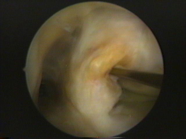 Artroscopia – PO = 1 ano – vista do enxerto LCP – momento da reconstrução do                  LCA c/ enxerto tendão patelar homólogo