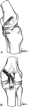 A = Fixação tibial “inlay”             B = Fixação transtibial