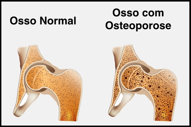 osteoporose