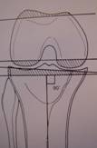 Fig.20-03 – Corte tibial e femoral – espaço em flexão retangular