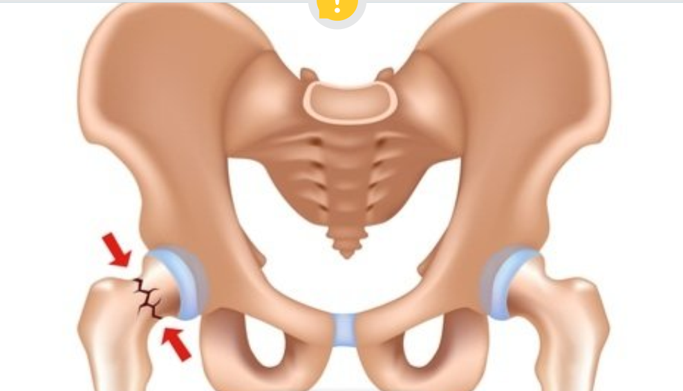 quadril do idoso fratura