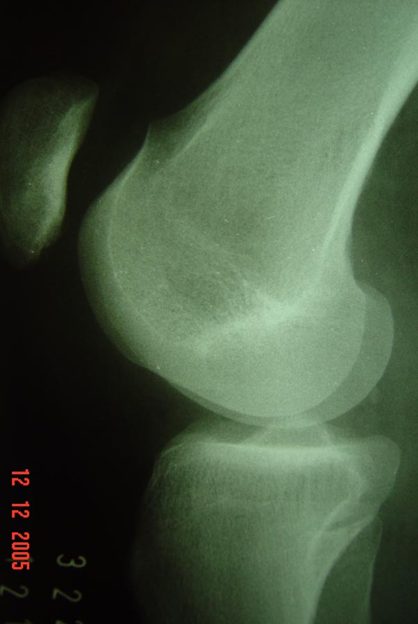 Fig12-01 – Displasia de tróclea femoral