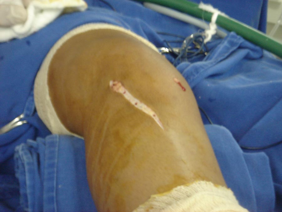 Fig12-03 – Incisão anterolateral de pele