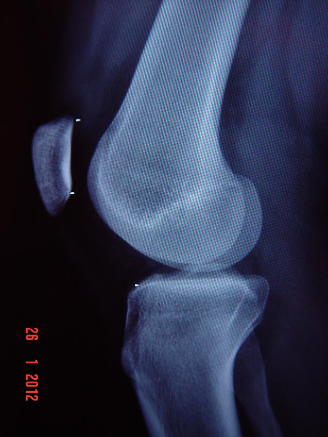 – Radiografia em perfil pré-operatória – Displasia de tróclea femoral e patela alta 