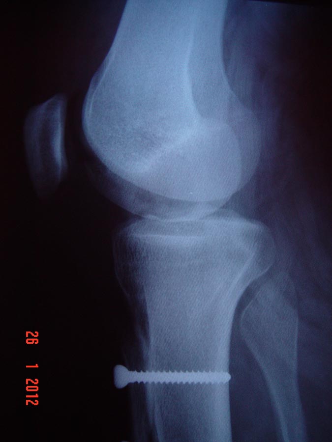 Radiografia em perfil pós-operatória – Realinhamento patelar distal