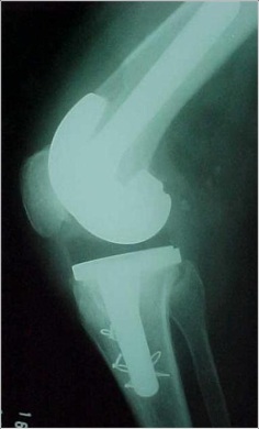 Fig.6-B – Osteotomia      da TAT