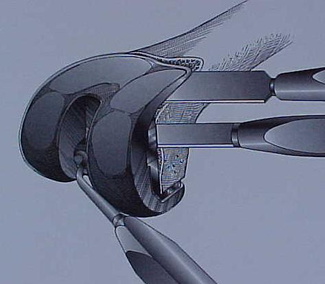 Fig.8-A – Esquema de retirada do componente femoral – osteótomos