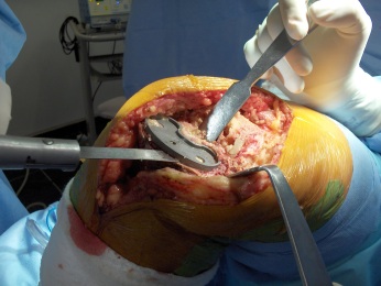 Fig.9-B – Retirada do componente tibial - cirurgia