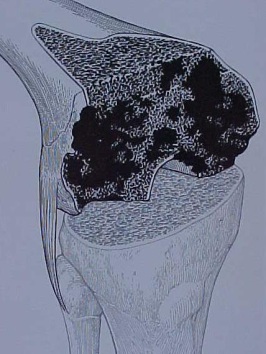 Fig.11-A – Esquema de defeito ósseo femoral