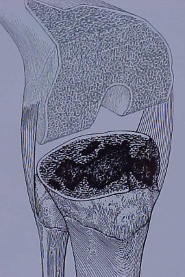 Fig.11-B – Esquema de defeito ósseo tibial