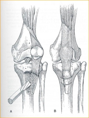 Fig.-14 – Osteotomia TAT