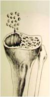 Fig.-24-A – Esquema do uso de enxerto ósseo moído