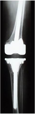 Fig.24-B – Radiografia pós-operatória de revisão com enxerto ósseo moído                   no planalto tibial medial.  