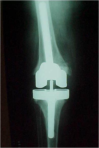 Fig.26-C – Radiografia pós-reconstrução com blocos metálicos no fêmur e tíbia