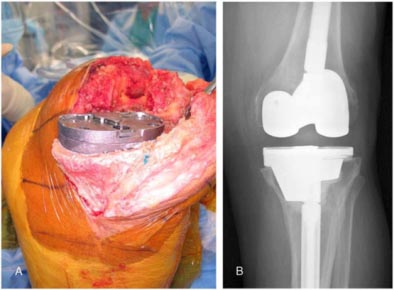 Fig.27-B – Perda óssea tibial tratada com “tantalum” e radiografia pós-operatória –                    Long e Scuderi (34)