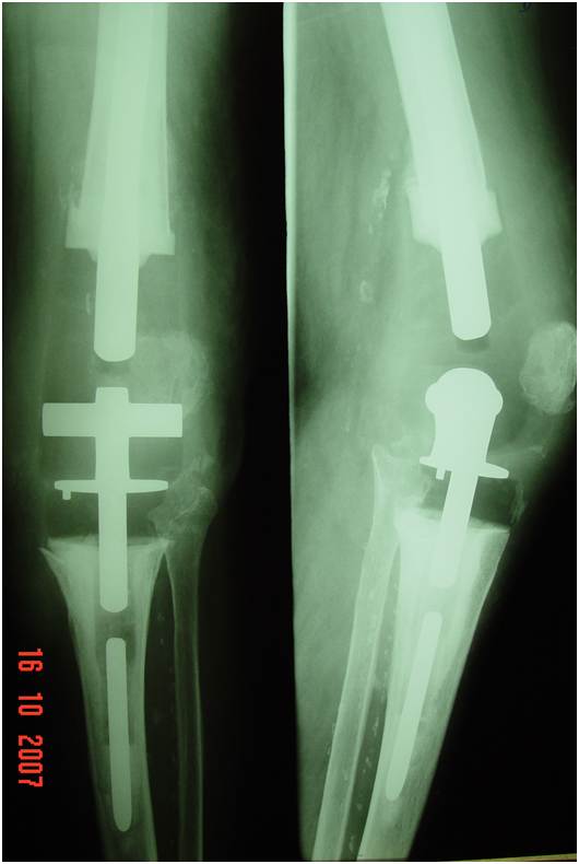 Fig.29 – Radiografia de prótese “tumoral”.