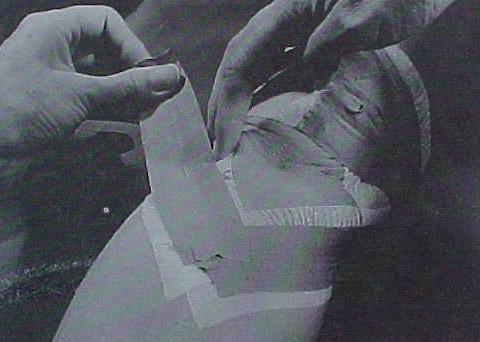 Fig. 14. Fitas / tiras (tapes). Fonte: Grelsamer RP, McConnell J. The patella: A team approach. 1998: 124.
