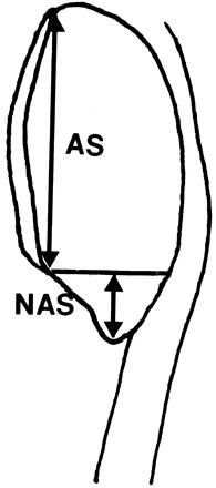 Fig.2 – Pólo inferior da patela alongado. AS – superfície articular; NAS – superfície não articular.