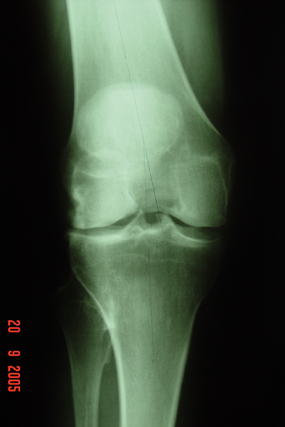 Fig. 1 – A-B: Radiografia joelho – AP com apoio monopodal – joelho DIR – ESQ. – Fonte: Hospital Novo Mundo (HNM) – Curitiba/PR