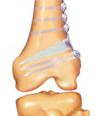 Fig. 2: Desenho de Osteotomia femoral de abertura tipo “PUDDU” – Fonte: www.arthrex.com