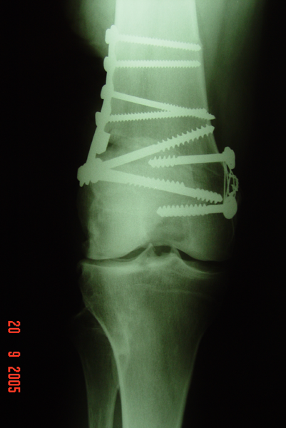 Fig.3 – A-B: Radiografia joelho DIR. - AP/perfil – pós-operatório imediato – osteotomial femoral varizante – Fonte: HNM  