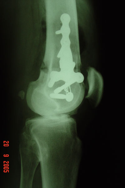 Fig.3-B – Joelho DIR – perfil