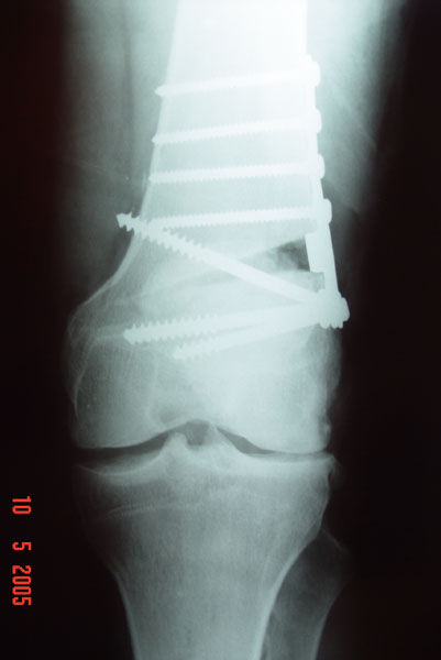 Fig. 4 – A-B: Radiografia joelho ESQ - AP/perfil – pós-operatório imediato – osteotomial femoral varizante – Fonte: HNM 