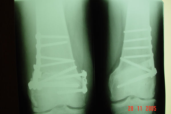 Fig. 5 – A - Radiografia joelho DIR-ESQ – AP – 3 meses pós-operatório – osteotomia femoral varizante (consolidada) – Fonte: HNM