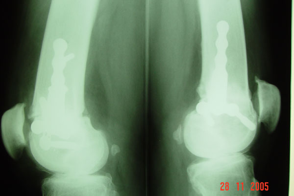 Fig.5 – B – Radiografia joelho DIR-ESQ – perfil – 3 meses pós-operatório